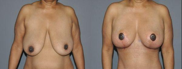 Breast Lift Before and After Photo by Dr. Yugueros in Johns Creek Georgia