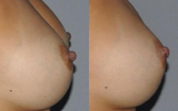 Nipple Reduction Before and After Photo by Dr. Yugueros in Johns Creek Georgia