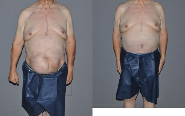 Post Massive Weight Loss Before and After Photo by Dr. Yugueros in Johns Creek Georgia