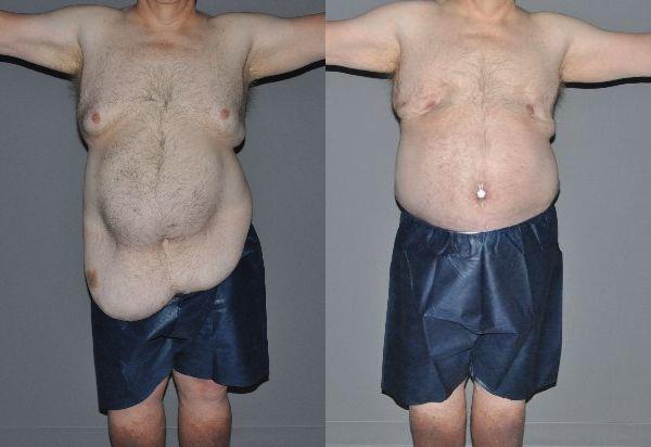 Post Massive Weight Loss Before and After Photo by Dr. Yugueros in Johns Creek Georgia