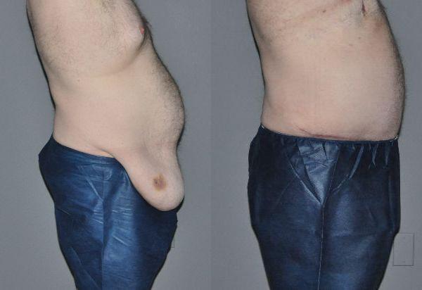 Post Massive Weight Loss Before and After Photo by Dr. Yugueros in Johns Creek Georgia