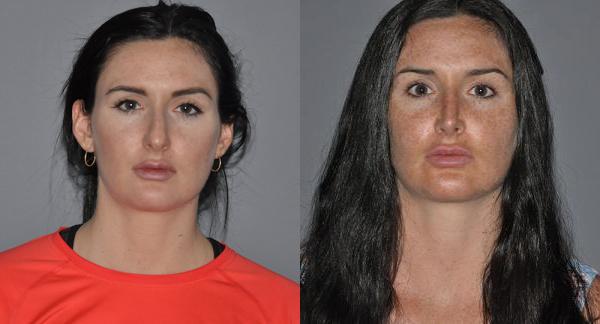 Rhinoplasty Before and After Photo by Dr. Yugueros in Johns Creek Georgia