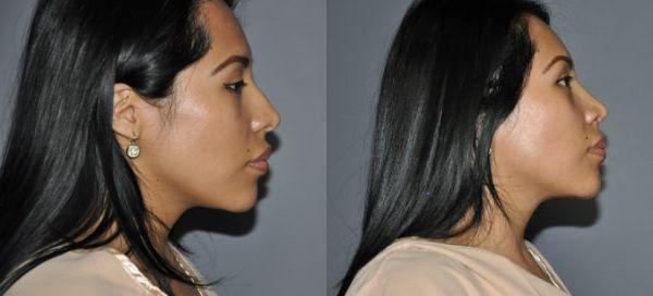 Rhinoplasty Before and After Photo by Dr. Yugueros in Johns Creek Georgia
