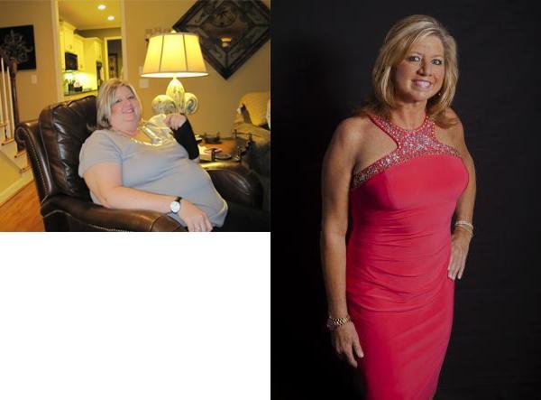 Gastric Bypass surgery Before and After Photo by Dr. Yugueros in Johns Creek Georgia