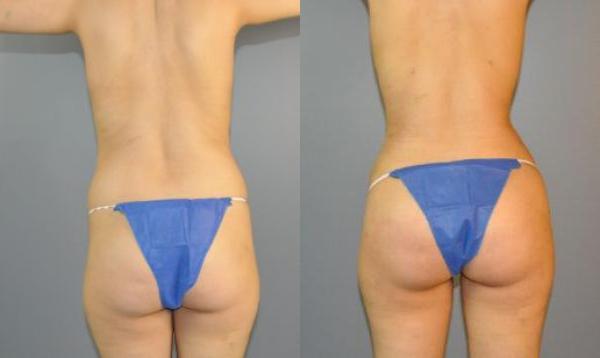 Before and After Result - Buttock Augmentation