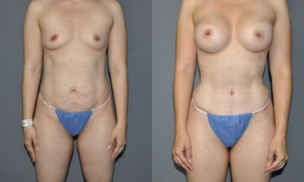 Mommy Makeover Before and After Photo - Tummy Tuck Procedure at Luna Plastic Surgery