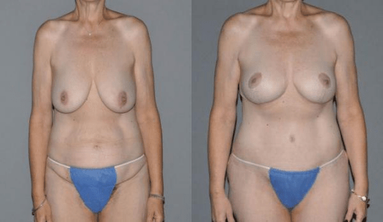 Mommy Makeover Before and After Photo - Thigh Lift Procedure with Upper Lift Procedures at Luna Plastic Surgery