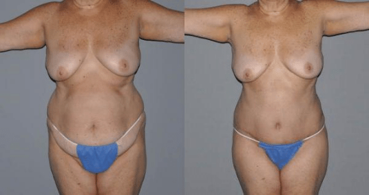 Mommy Makeover Before and After Photo - BodyTite Procedure
