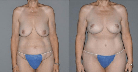 Mommy Makeover Before and After Photo - BodyTite Procedure