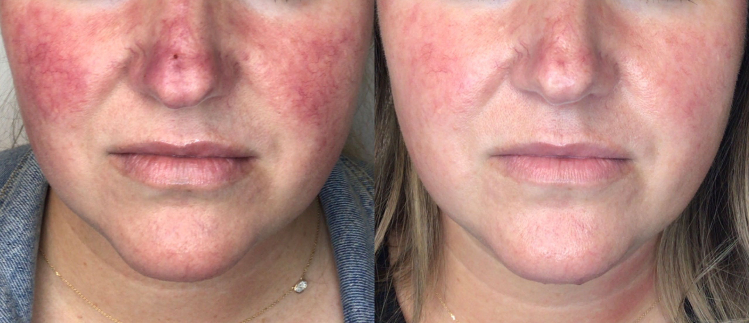 ipl before and after patient ipl before and after patient