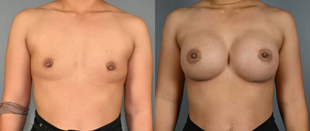Breast Augmentation Before and After Photo by Dr. Yugueros in Johns Creek Georgia