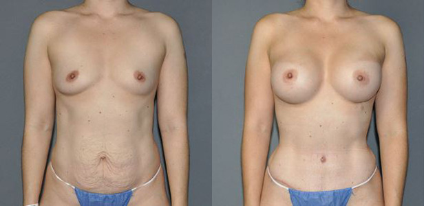 Mommy Makeover Before and After Photo by Dr. Yugueros in Johns Creek Georgia
