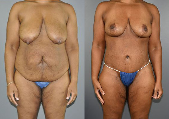 Mommy Makeover Before and After Photo by Dr. Yugueros in Johns Creek Georgia