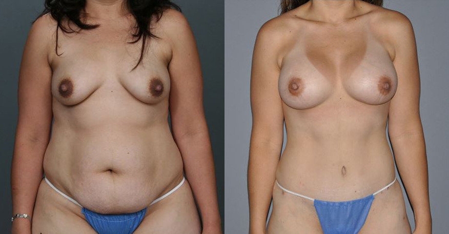 Mommy Makeover Before and After Photo by Dr. Yugueros in Johns Creek Georgia