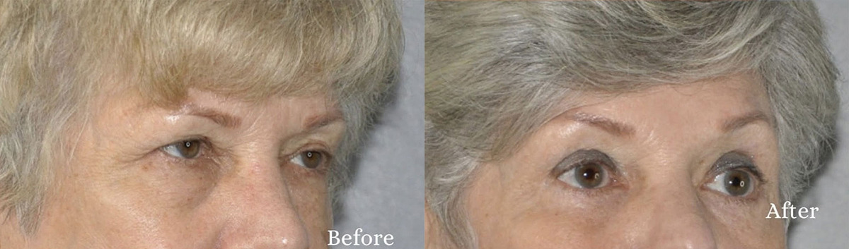 Upper Blepharoplasty Before and After Photo by Dr. Yugueros in Johns Creek Georgia
