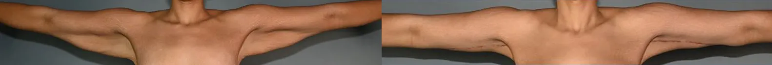 Arm Lift Before and After Photo by Dr. Yugueros in Johns Creek Georgia