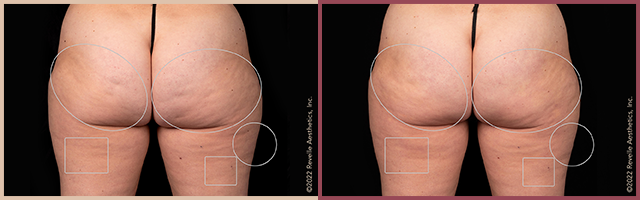 Aveli Before and After Photo by Dr. Yugueros in Johns Creek Georgia