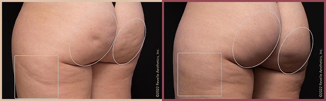 Aveli Before and After Photo by Dr. Yugueros in Johns Creek Georgia