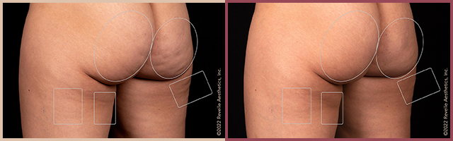 Aveli Before and After Photo by Dr. Yugueros in Johns Creek Georgia