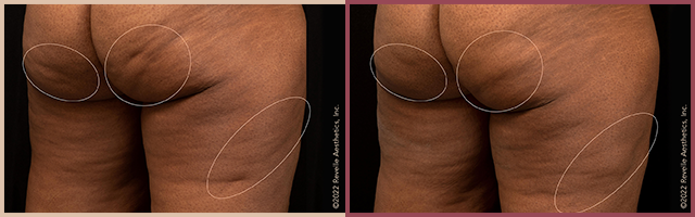 Aveli Before and After Photo by Dr. Yugueros in Johns Creek Georgia