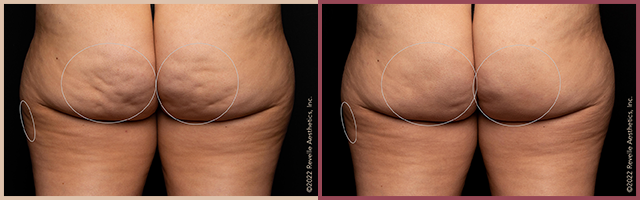 Aveli Before and After Photo by Dr. Yugueros in Johns Creek Georgia