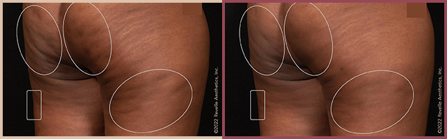 Aveli Before and After Photo by Dr. Yugueros in Johns Creek Georgia