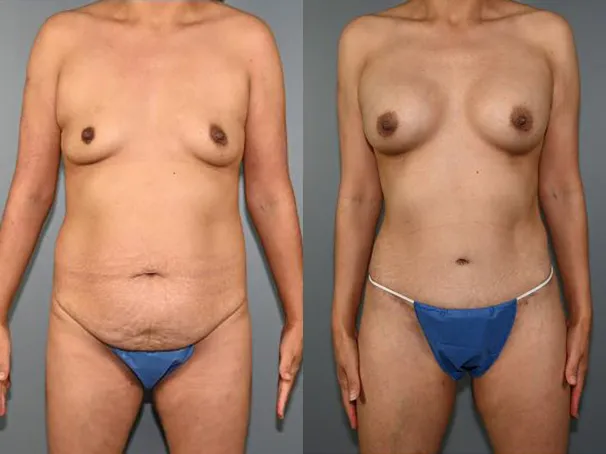 Mommy Makeover Before and After Photo by Dr. Yugueros in Johns Creek Georgia