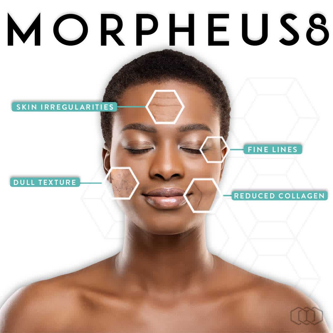 Morpheus8 treatment targets skin issues.