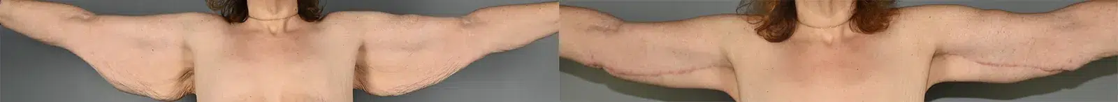 Front View Arm Lift Before and After Photo by Dr. Yugueros