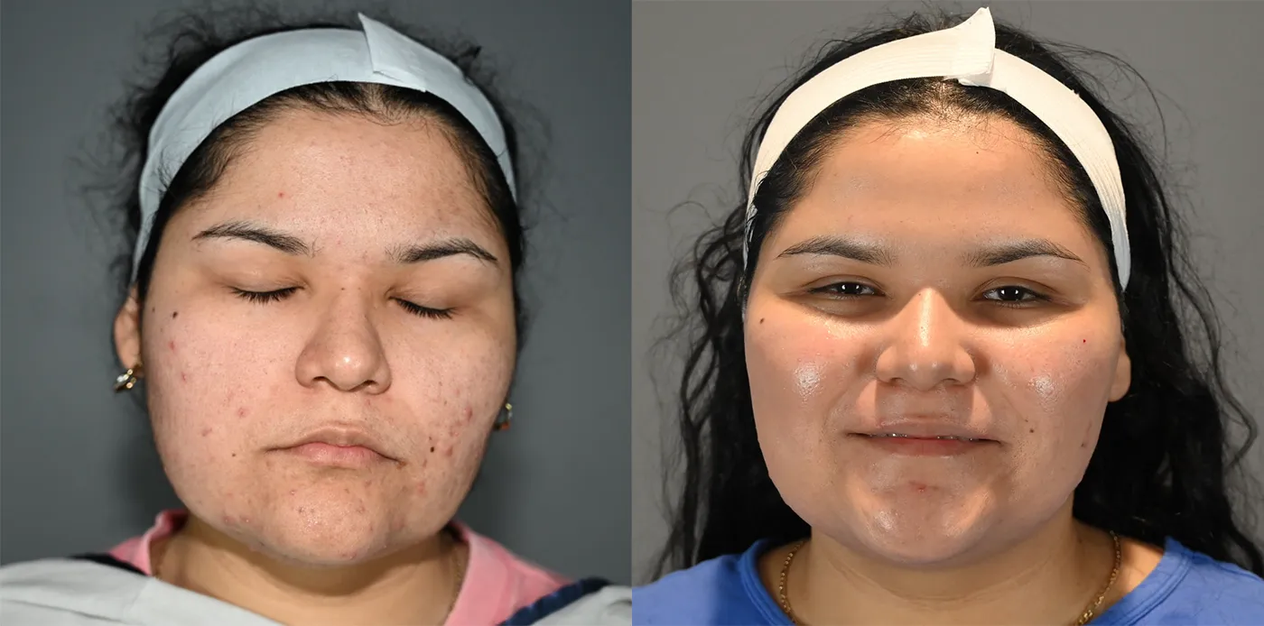 Front View Spa Treatments Before and After Photo by Dr. Yugueros
