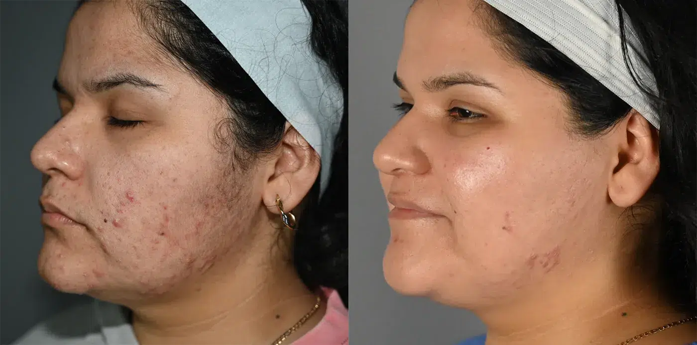 Left Oblique View Spa Treatments Before and After Photo by Dr. Yugueros